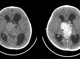 Reirradiación de gliomas grandes o multifocales
